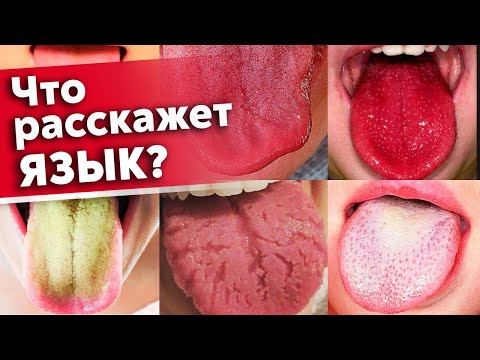 Язык предупредит вас о болезнях! | Как диагностировать состояние организма по языку?