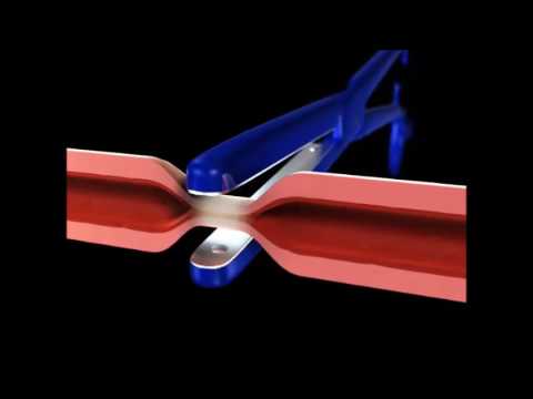 marClamp® – Features and functions