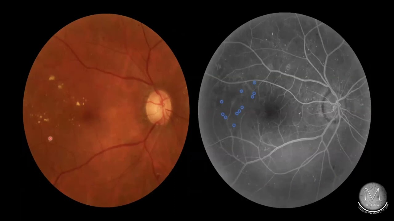 FFA for Diabetic Retinopathy and DME