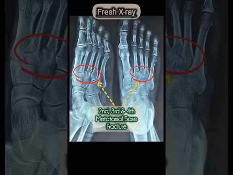 Orthopaedic Health camp