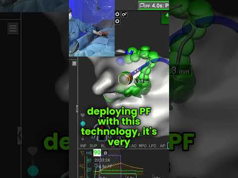 Affera Mapping and Ablation System with Sphere-9… - Partner