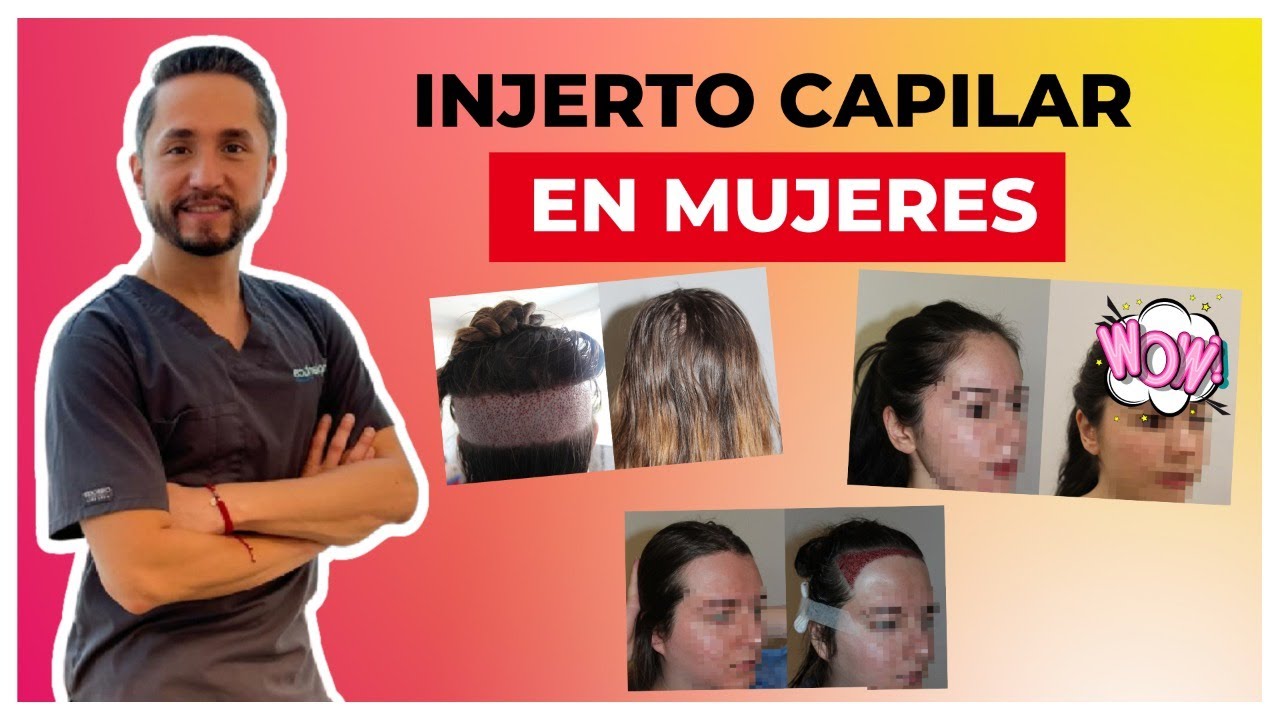 ??????????Injerto de Cabello en MUJERES Antes y Después (parte 2)