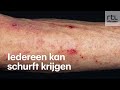 Vreselijke jeuk en erg besmettelijk: dit is schurft