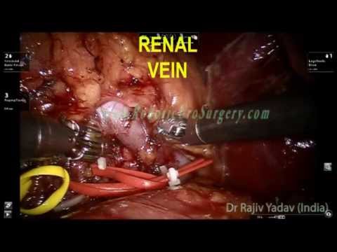 Robotic Partial Nephrectomy For Kidney Cancer 