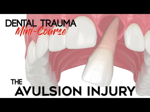 Dental Trauma Mini-Course - Part 12 - Dental Trauma Guide - The Avulsion Dental Injury