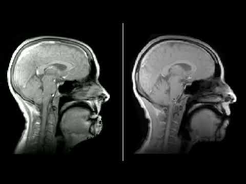 Ultra-rapid anatomical MRI processing: speaking / singing