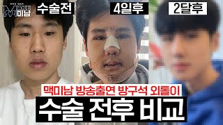 AB TV - 성형 수술 케이스 리뷰 후기