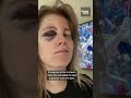 Toronto Blue Jays Fan Hit In Face By 110mph Foul Ball TO Baseball BoBichette