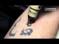 Лазерное удаление нежелательной татуировки 