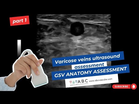 Part 1: Varicose veins ultrasound assessment: GSV anatomy assessment