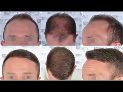 Manual FUE Hair Transplant Before & After, 5015 Grafts Result - ASMED - Dr. Koray Erdogan