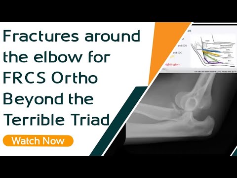 Fractures Around the Elbow