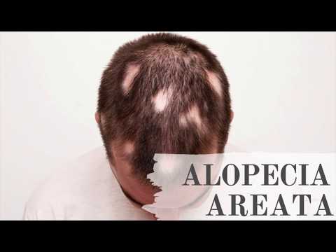 FATEC DIADEMA ALOPECIA AREATA