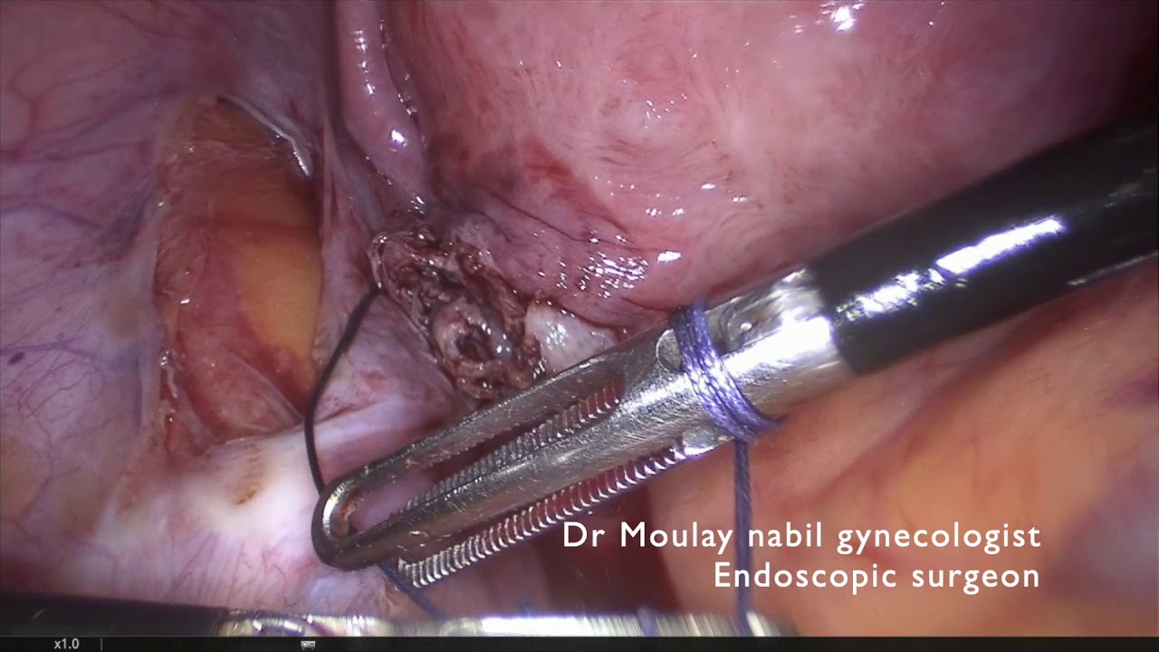 Outpatient laparoscopic myomectomy
