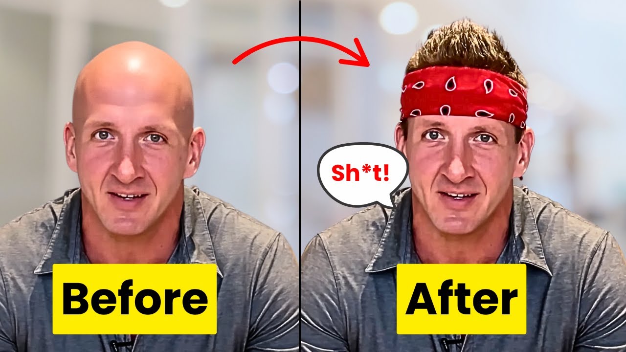 $3000 Hair Transplant Mistake in Thailand? What They DON'T Show You