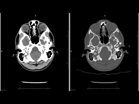 Head CT (computed tomography) radiology search pattern