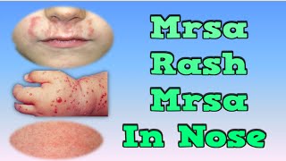 Mrsa Rash, Mrsa In Nose, Mrsa Bumps, Bacteria Mrsa, Mrsa Abscess, What Is Mrsa Disease, Virus Mrsa