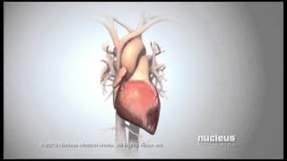 Acute Coronary Syndrome