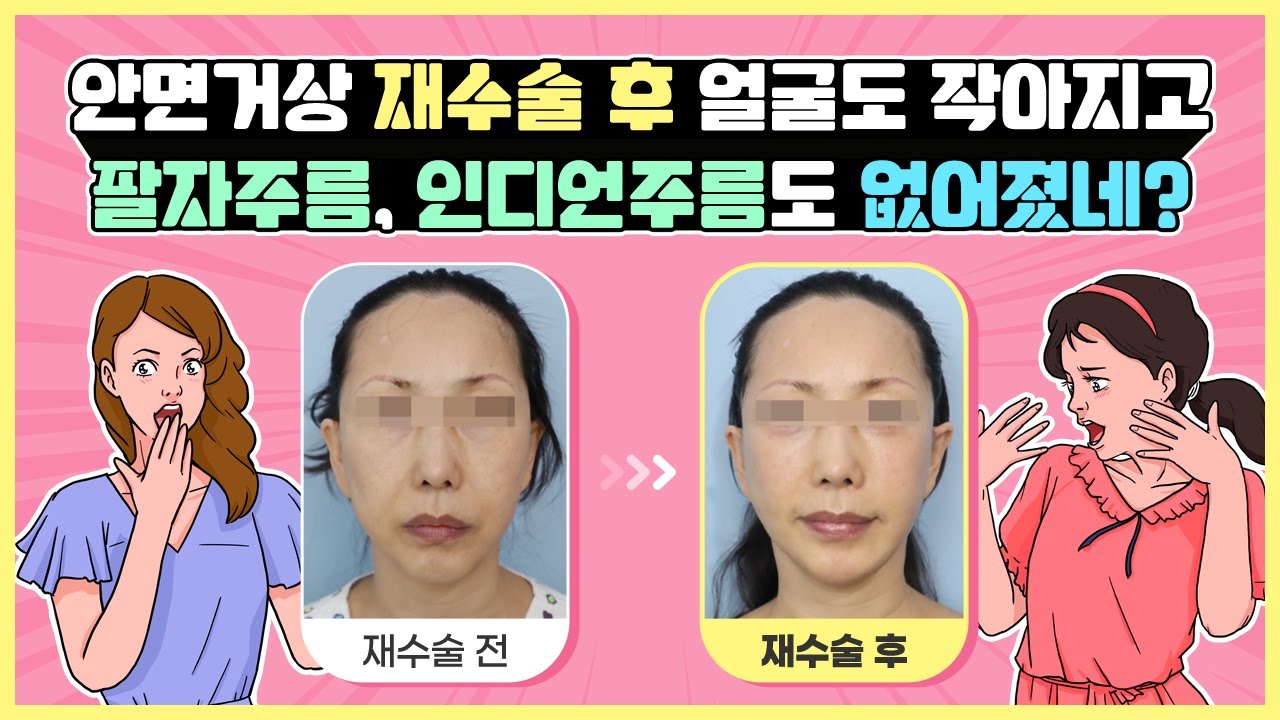 안면거상재수술 후 작은얼굴, 팔자주름과 인디언주름이 없어졌다! | 안면거상복원수술잘하는 병원 | 키다리성형외…