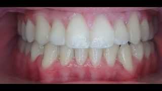 preview picture of video 'Orthodontic Treatment Before and After Morph | Marin Ortho'