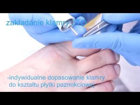 Guzki na tylnej części stopy Koślawego autobus Almaty