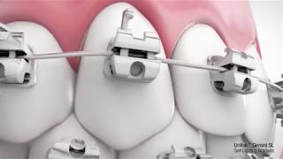 NIỀNG RĂNG MẮC CÀI 3M UGSL - AN TOÀN, HIỆU QUẢ CAO