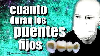 🔵PROBLEMAS con los PUENTES FIJOS sin IMPLANTES