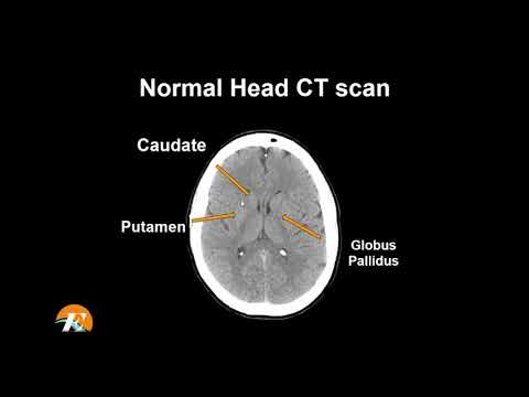 image-How do you view a CT scan of the brain? 