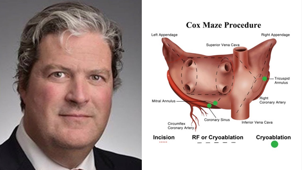 Dr. Jonathan Philpott Performs a Concomitant Biatrial Cox Maze IV Procedure