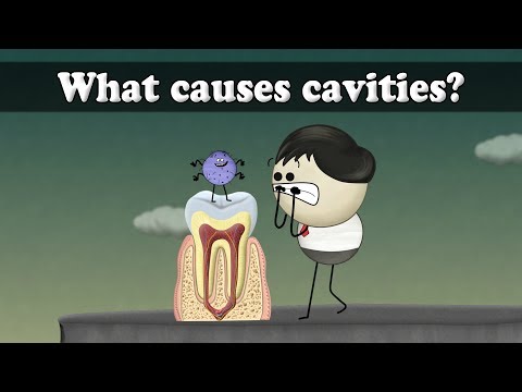 虫歯の原因は?| 虫歯の原因は? (What causes cavities? | #aumsum)