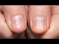 If You Have Ridges On Your Fingernails It Means This