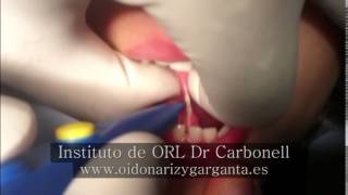 Frenillo lingual - Instituto de ORL Dr Carbonell