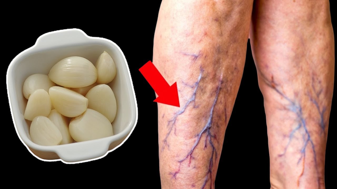 Unbelievable!😍 Destroys Varicose Veins and Inflammation naturally (Did you know that?)
