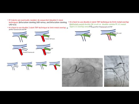 Left main trifurcation strategies