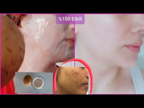 hogyan lehet fehéríteni az arcodat a vörös foltoktól