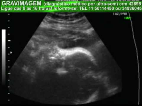 GRAVIMAGEM 2343 (ULTRASSOM GRAVIDEZ 3D 4D 33 SEMANAS).mp4