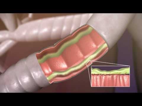 How the Aerobika* OPEP Device Works
