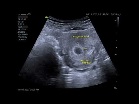 SEMANA 5 DE LA GESTACIÓN Y AUN NO SE PERCIBE EL EMBRIÓN ES NORMAL ???
