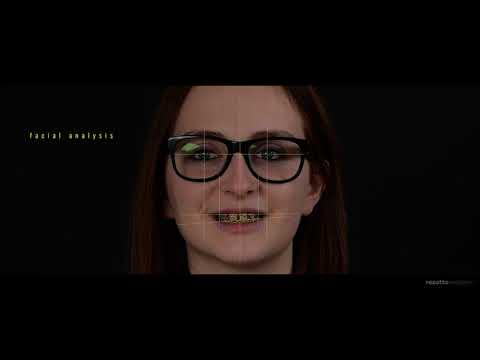 Partial Anodontia Treatment – Zirconia Frameworks [Alina´s Story]