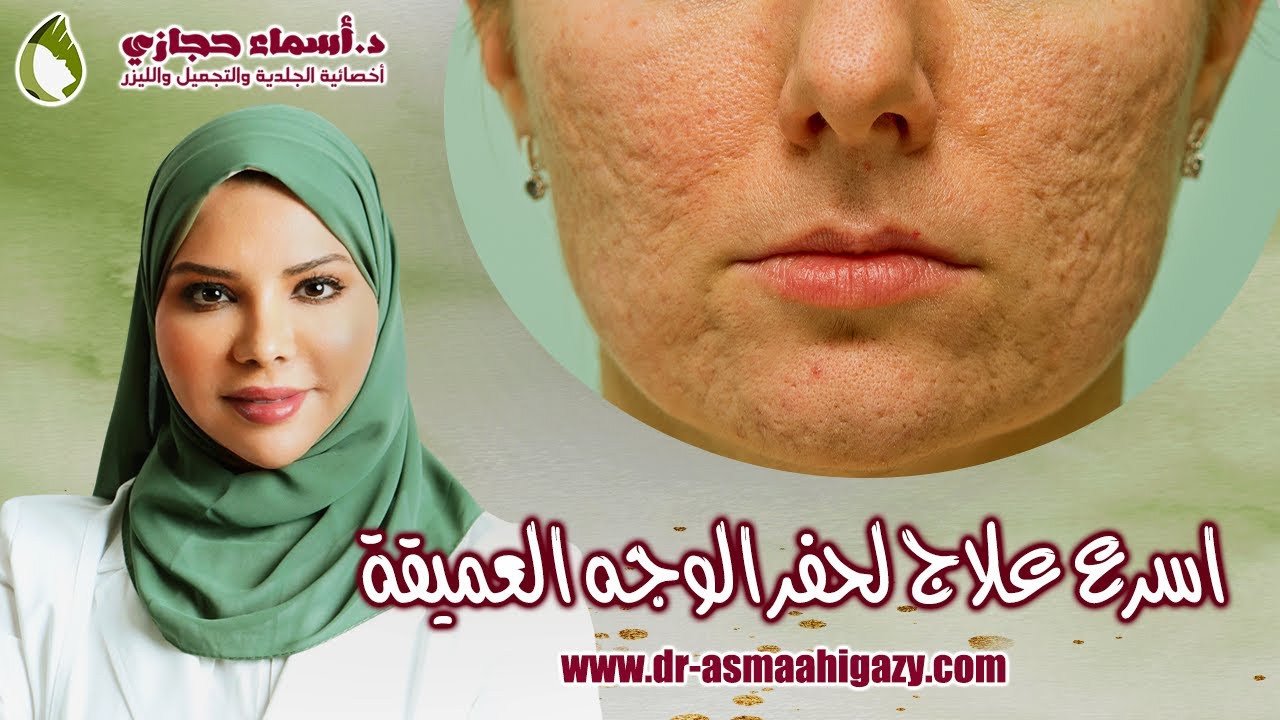 علاج حفر الوجه نهائيا أحدث طرق علاج الندبات بنتائج سحرية و سريعة 2022 | دكتور أسماء حجازي