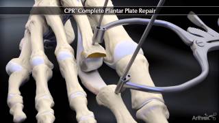 Plantar Plate Repair