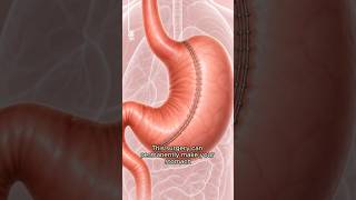 Stomach Shrinking