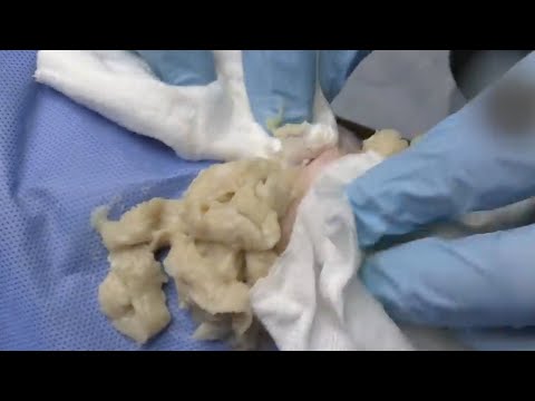 Explosive CYST on the knee