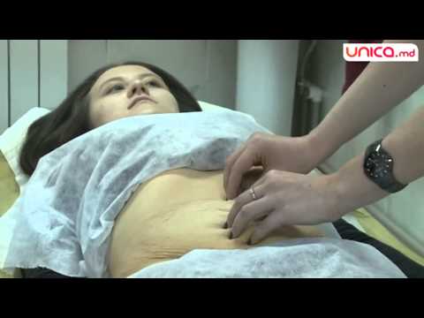 Mezolipoliza și metoda Subcision pentru restabilirea pielii lăsate a abdomenului și SPA facial