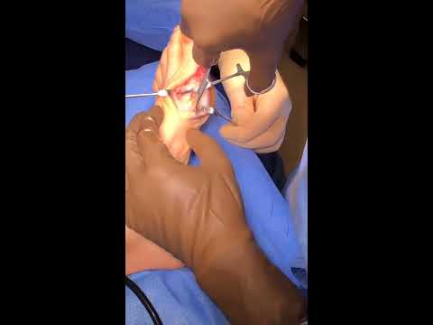 Chevron/Akin Osteotomy Bunion Surgery