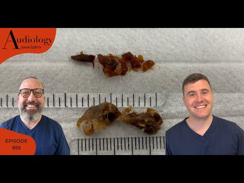 VERY FULL EAR CANAL & SATISFYING EAR WAX REMOVAL - EP855