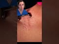How CO2 Lasers Can Help Smooth Your Skin