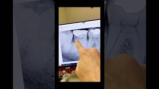 No cbct. #dentists #foreigntraineddentist #dentalcare #rootcanaltherapy #dentalprosthesis