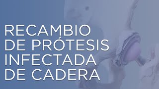 Cambio de prótesis de cadera infectada | prótesis de cadera | infección de cadera  | IQTRA