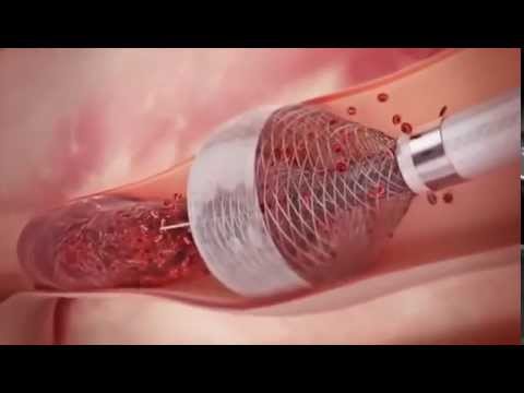 Seems Nice new technic to remove clots from heart